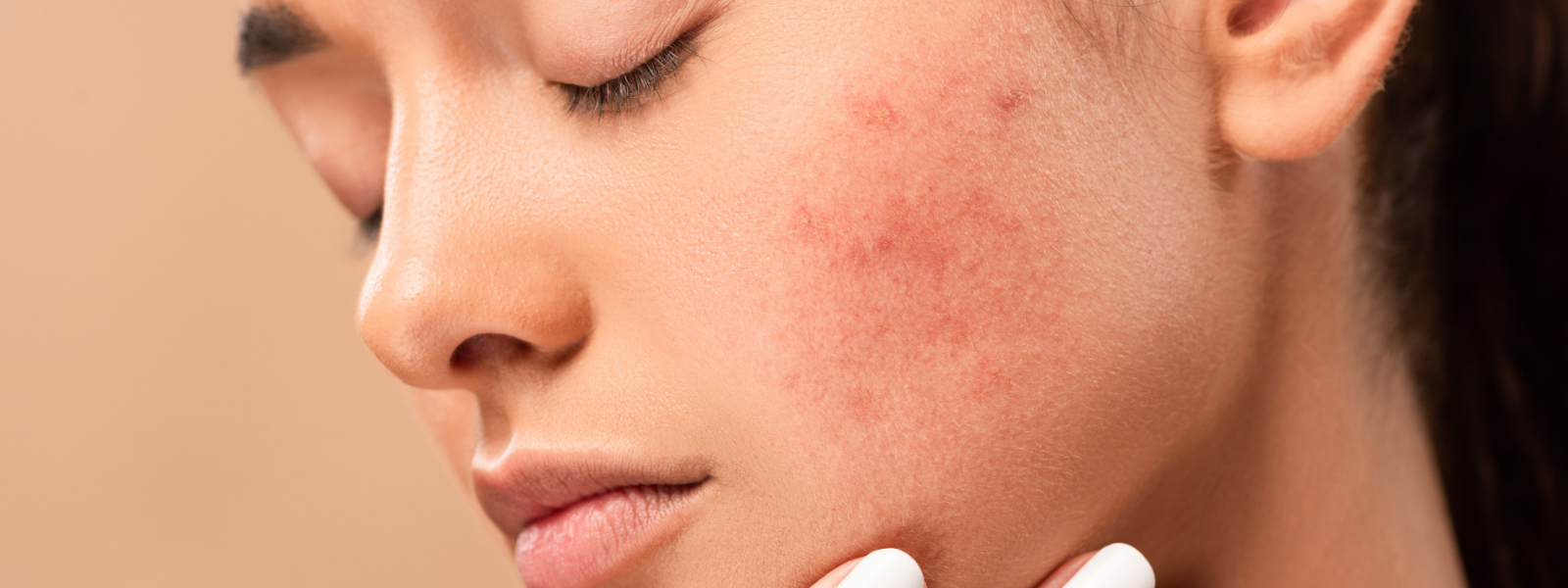 Acne and Acne Scarring