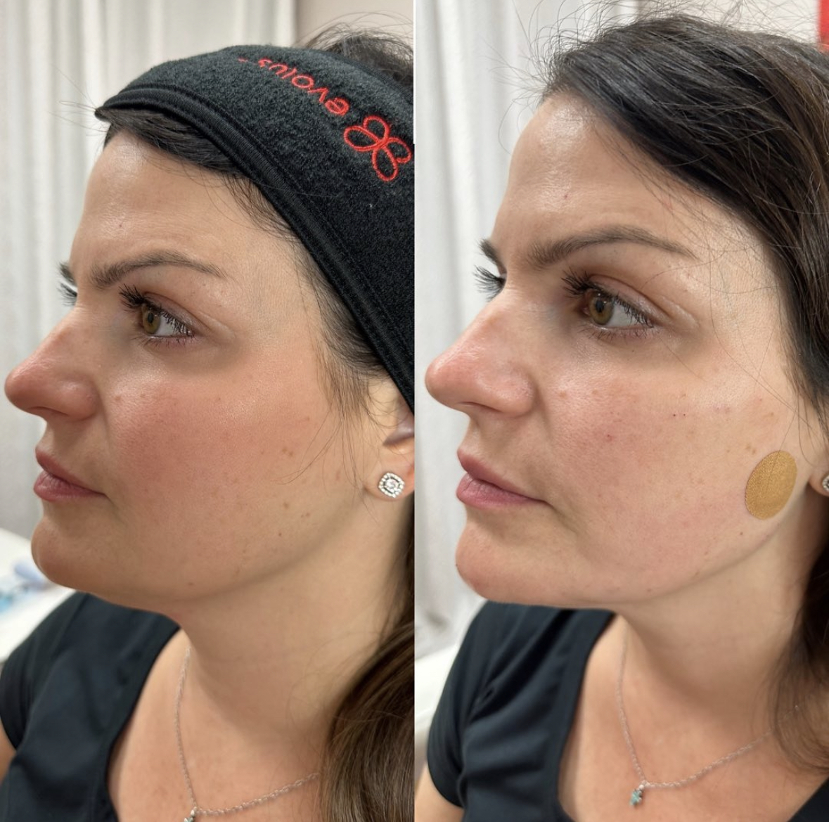 Before and after results for PDO Thread Lifts